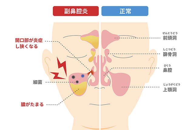 副鼻腔炎のイラスト